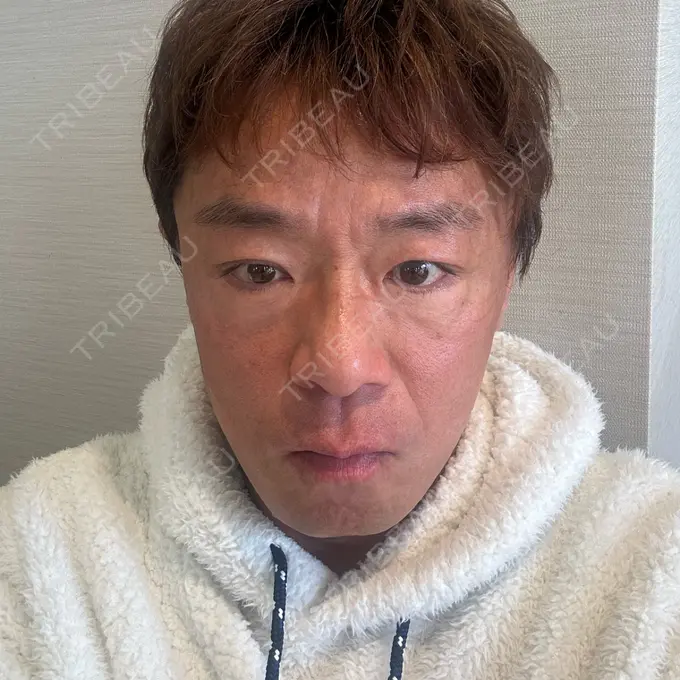 肌ヒアルロン酸注入（たるみ・シワ改善） / シワ取りボトックス / ボトックス（眉間） TCB東京中央美容外科 長野院 BEFORE メイン用