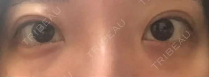 クマ治療 / 下まぶたの脂肪取り / 脂肪注入（肌） / 肌ヒアルロン酸注入（たるみ・シワ改善） 湘南美容クリニック 八王子院 BEFORE メイン用