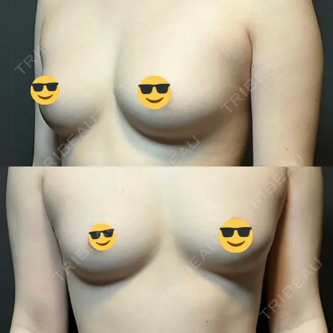 豊胸（シリコンバッグ） MYCLI【マイクリ】東京・恵比寿院 BEFORE メイン用