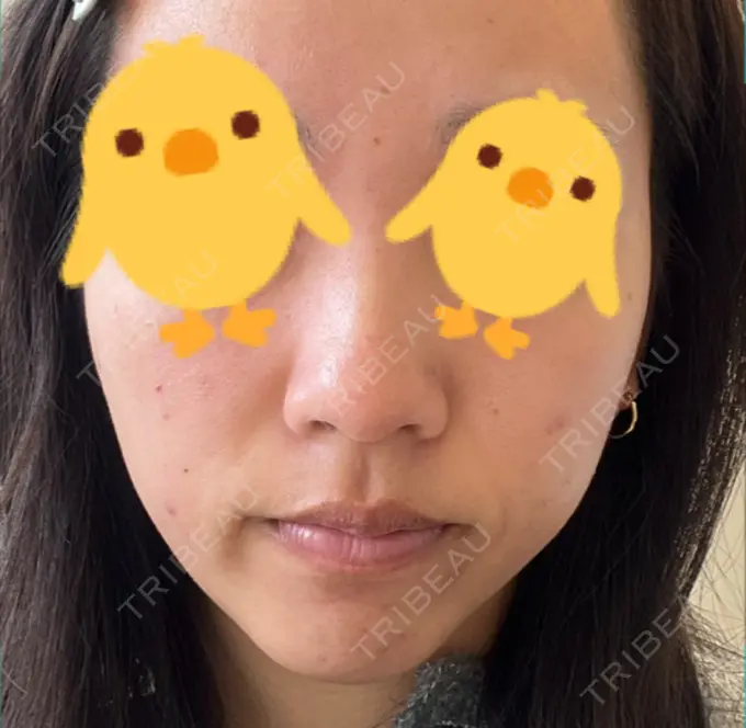 鼻尖形成（切開） / 軟骨移植 / 鼻尖縮小 / GLP-1ダイエット 東京シンデレラ美容外科 新宿院 BEFORE メイン用