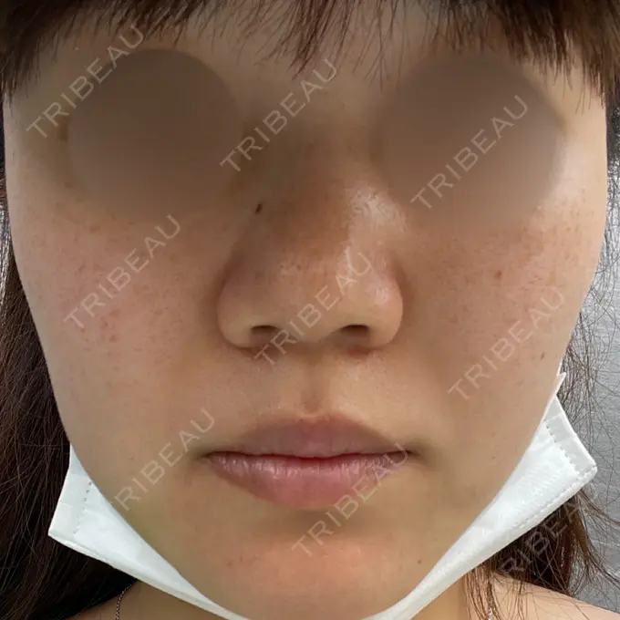 ピーリング（ニキビ・毛穴） / ルメッカ ルラ美容クリニック 名古屋本院 BEFORE メイン用