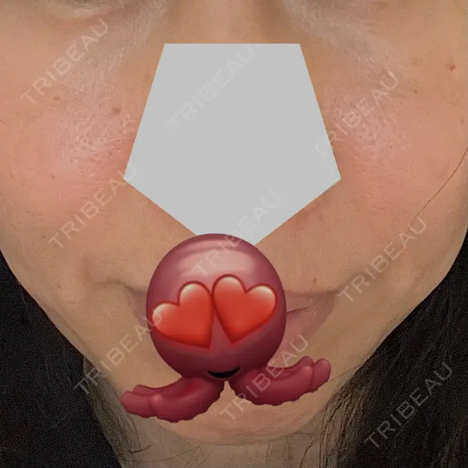 イオン導入 / ピコレーザートーニング（美白・肝斑） ルラ美容クリニック 福岡本院 BEFORE メイン用