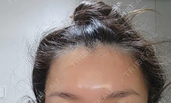 脂肪溶解注射（顔） / ボトックス（目尻） / ボトックス（額） TCB東京中央美容外科 名古屋栄院 BEFORE メイン用