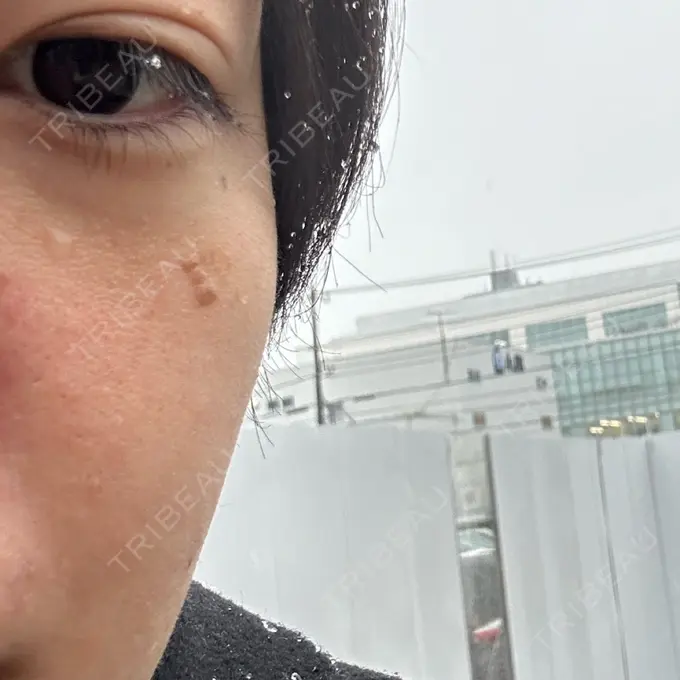 ほくろ・いぼ除去レーザー（肌） Mavie Beauty Clinic （マヴィービューティークリニック） BEFORE メイン用