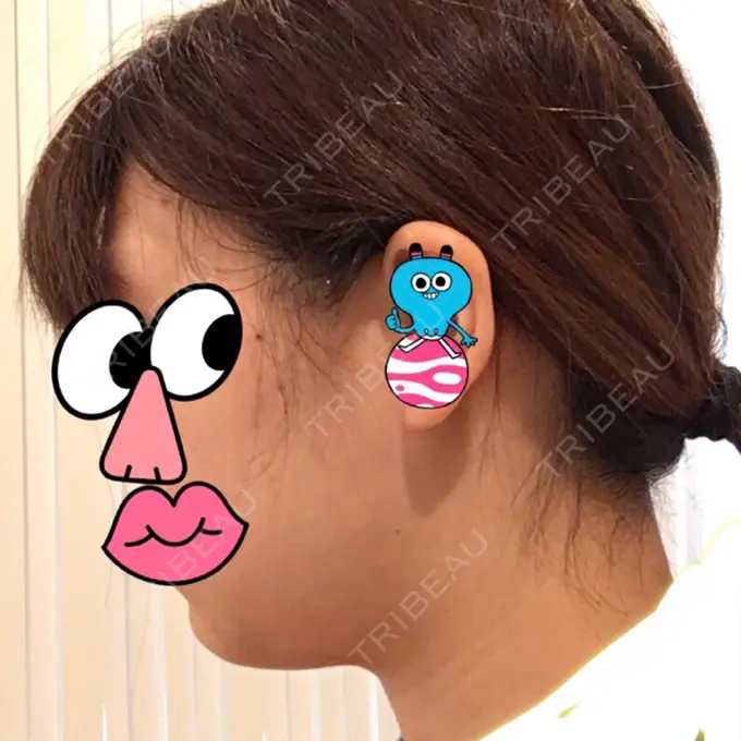 脂肪吸引（顔） みずほクリニック BEFORE メイン用