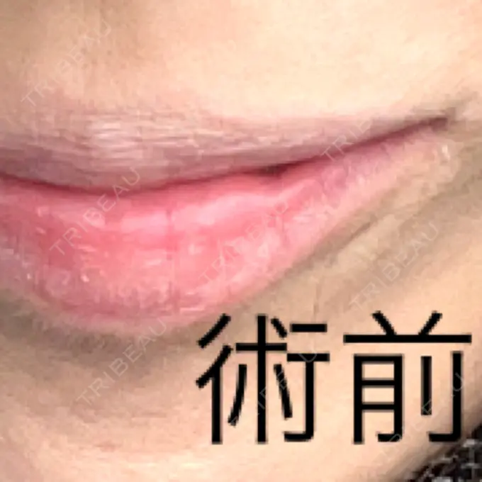 ヒアルロン酸注入（唇） 共立美容外科 大分院 BEFORE メイン用