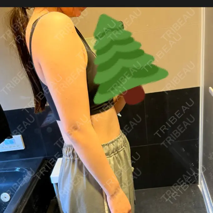 医療痩身（お腹） / 医療痩身（二の腕） 湘南美容クリニック 大阪梅田本院 BEFORE メイン用