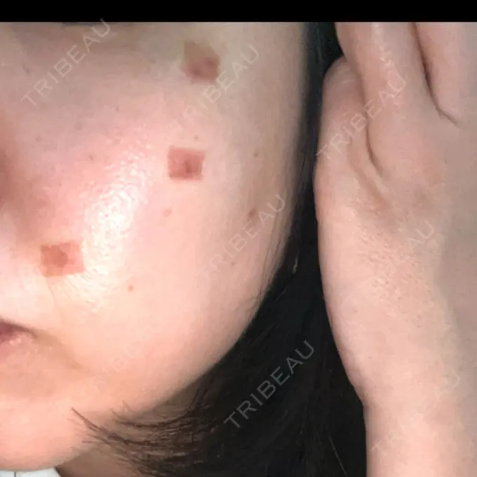 ピコスポット G MEDICAL ART クリニック 新宿院 BEFORE メイン用