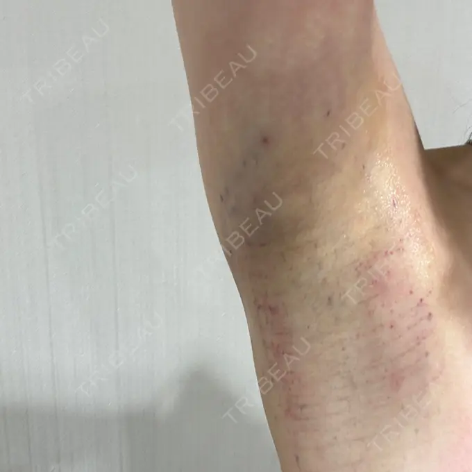 ワキ汗治療（レーザー） Fellez Clinic【フェルズクリニック】 BEFORE メイン用