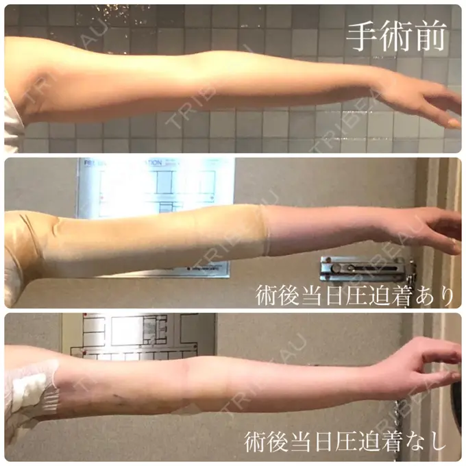 脂肪吸引（二の腕） ヨンセスリムライン BEFORE メイン用