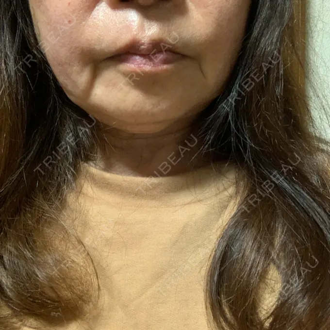 その他（肌） メディアージュクリニック 青山院 BEFORE メイン用