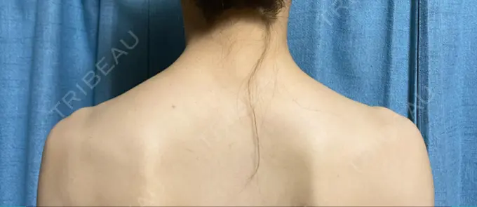 ボトックス（肩） 共立美容外科 名古屋院 BEFORE メイン用