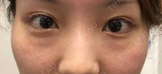 クマ治療 R Beauty CLINIC 名古屋院 BEFORE メイン用