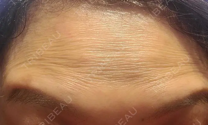 ボトックス（額） ルヴィクリニック イオンドーム前院 BEFORE メイン用