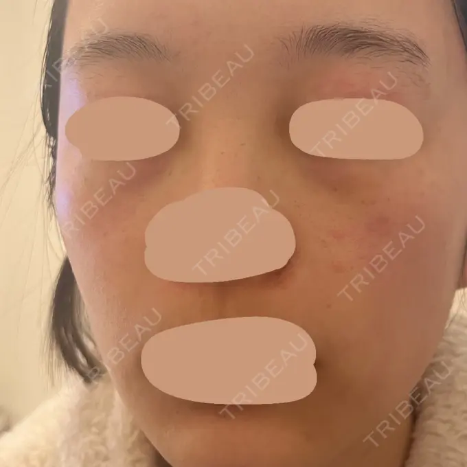 エレクトロポレーション / ルメッカ ゆきスキンクリニック 東池袋 BEFORE メイン用