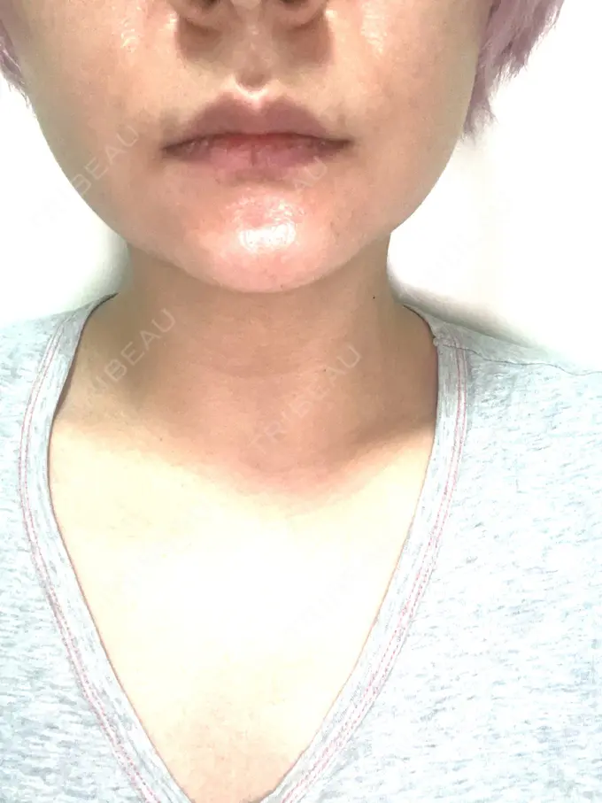 ボトックス（エラ・小顔） TCB東京中央美容外科 仙台広瀬通院 BEFORE メイン用