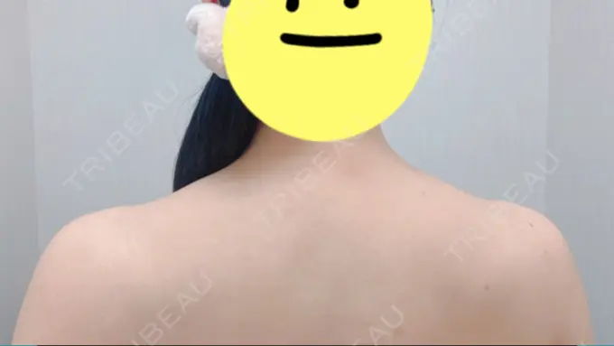 ボトックス（肩） 共立美容外科 京都院 BEFORE メイン用
