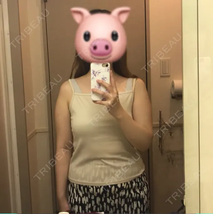 脂肪吸引（二の腕） / 脂肪吸引（肩） / その他 湘南美容クリニック 銀座院 BEFORE メイン用