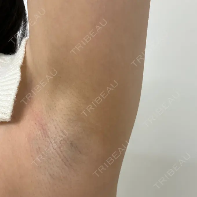 医療脱毛（ワキ） 湘南美容クリニック 秋葉原院 BEFORE メイン用