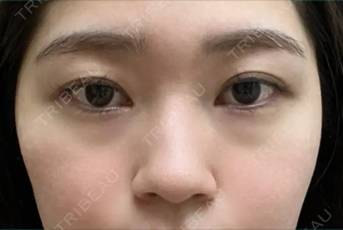 クマ治療 / 脂肪注入（目の下） 吉井クリニック BEFORE メイン用