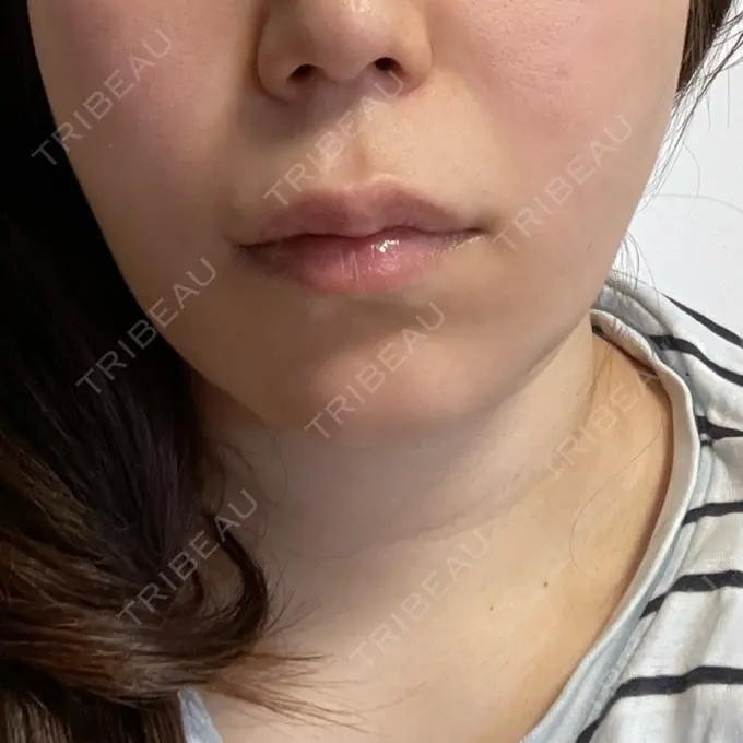 小鼻縮小（切開） / 糸リフト / 人中短縮 / 鼻翼挙上 / 口角挙上 / メーラーファット除去 / ボトックス（口角） Otus Clinic 【オータスクリニック】 BEFORE メイン用