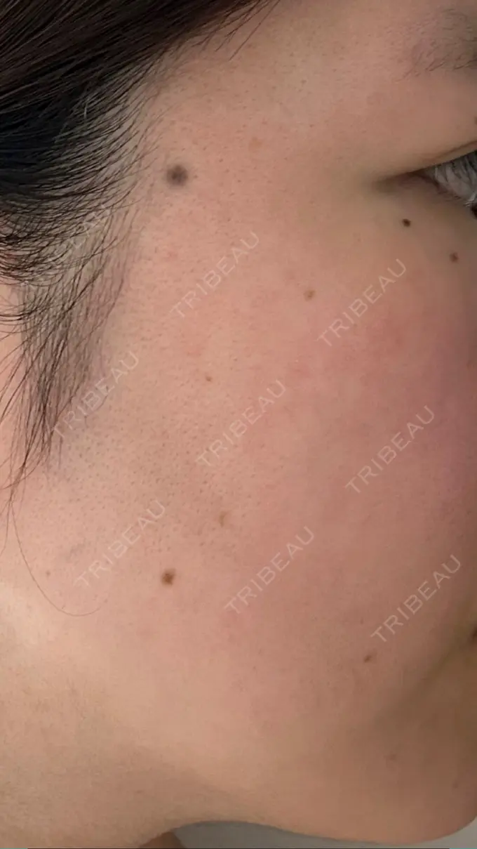 ルメッカ ルラ美容クリニック 高田馬場院 BEFORE メイン用