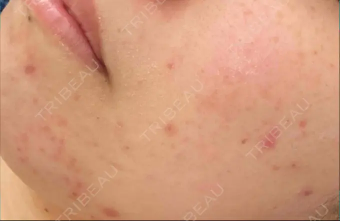 ピーリング（ニキビ・毛穴） / イオン導入 渋谷美容外科クリニック 渋谷院 BEFORE メイン用