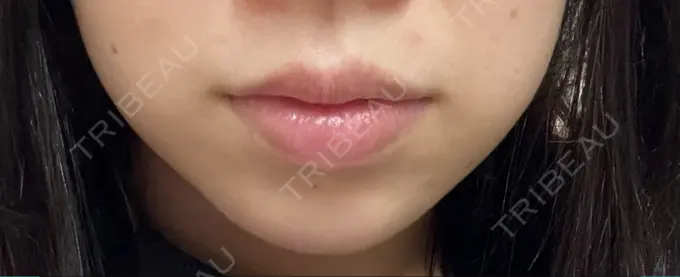 ハイフ（顔） ミニマムスキンクリニック池袋 BEFORE メイン用