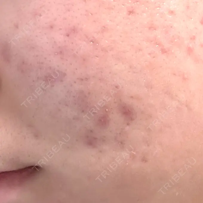 毛穴洗浄（ハイドラフェイシャルなど） / 光治療（フォトフェイシャルなど） ミニマムスキンクリニック池袋 BEFORE メイン用