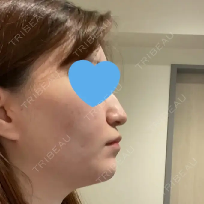 脂肪吸引（顔） / ボトックス（エラ・小顔） Otus Clinic 【オータスクリニック】 BEFORE メイン用