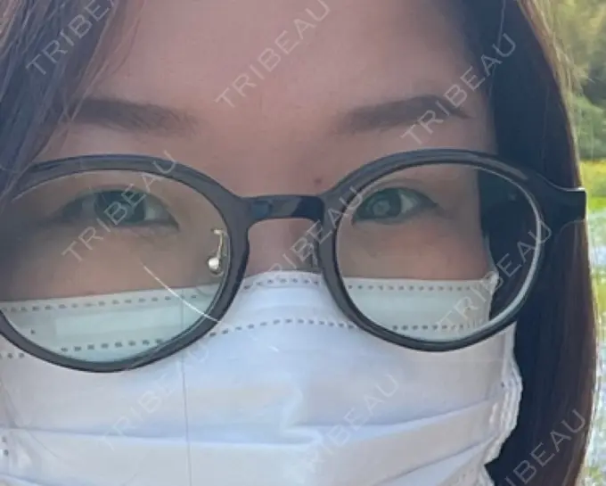 二重埋没 / 自然癒着法 CLINIC W BEFORE メイン用