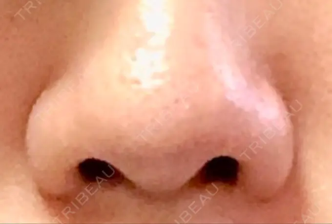 小鼻縮小（切開） 共立美容外科 高松院 BEFORE メイン用