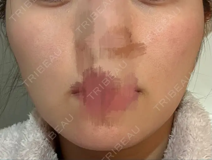 脂肪溶解注射（顔） 吉祥寺アイビークリニック BEFORE メイン用