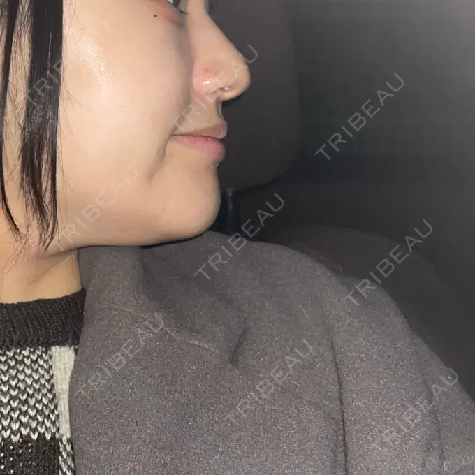 糸リフト / 脂肪吸引（顔） 東京シンデレラ美容外科 大宮院 BEFORE メイン用