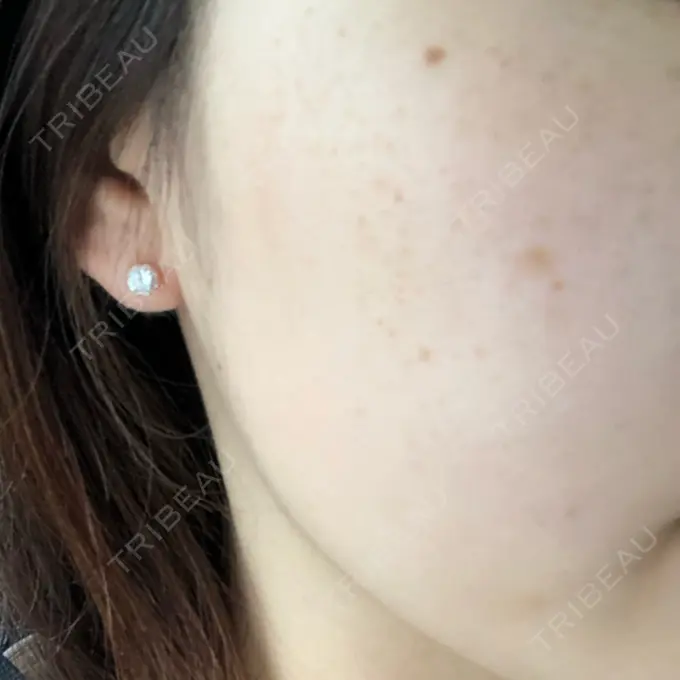 シミ取りレーザー 野口皮膚科医院 BEFORE メイン用