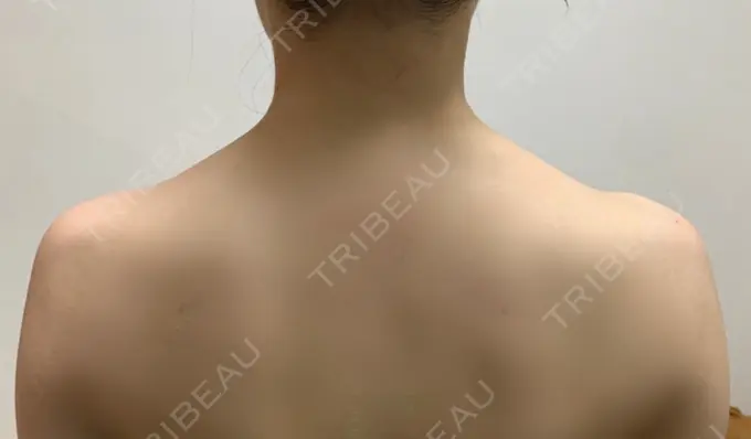 ボトックス（肩） / ボトックス（眉間） / ボトックス（額） ルラ美容クリニック 大阪本院 BEFORE メイン用