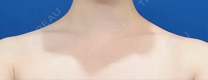 ボトックス（肩） 共立美容外科 名古屋院 BEFORE メイン用