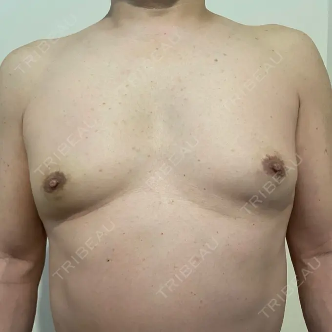 胸修正 / その他（胸） Mods Clinic（モッズクリニック） 大阪院 BEFORE メイン用