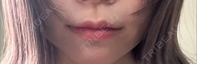 ヒアルロン酸注入（唇） ネビュラクリニック 東京錦糸町院 BEFORE メイン用