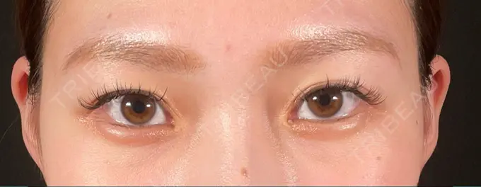 二重埋没 / クマ治療 / その他（目元） R Beauty CLINIC 大阪院 BEFORE メイン用