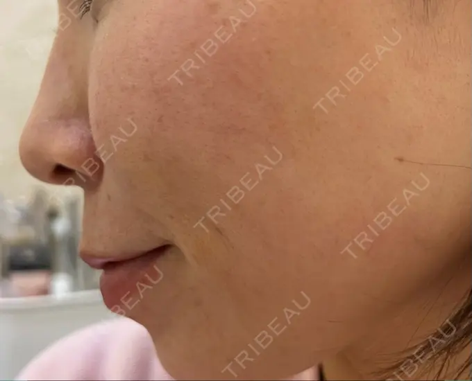 レーザートーニング（美白・肝斑） 椿クリニック 心斎橋院 BEFORE メイン用