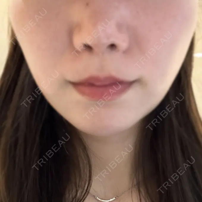 脂肪溶解注射（顔） 表参道ウィズ・クリニック BEFORE メイン用