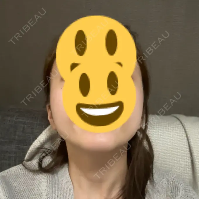 ボトックス（エラ・小顔） TCB東京中央美容外科 自由が丘院 BEFORE メイン用