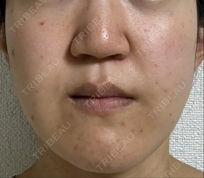 脂肪吸引（顔） スノウ（Snow）整形外科 BEFORE メイン用