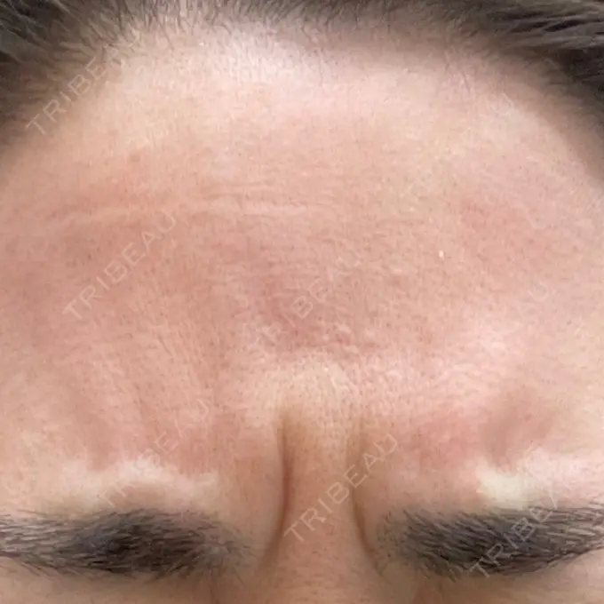 ボトックス（眉間） / ボトックス（額） 湘南美容クリニック 金山院 BEFORE メイン用