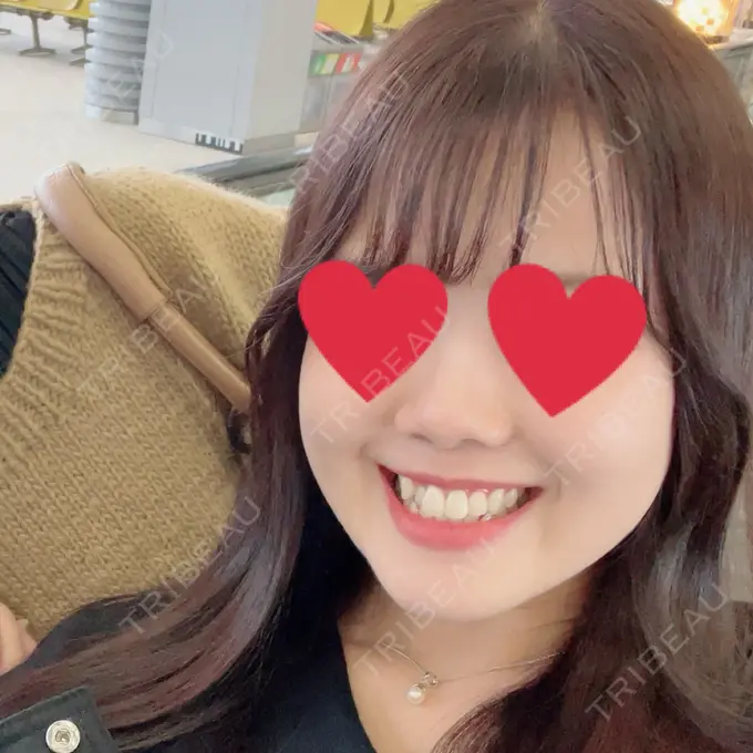 ボトックス（エラ・小顔） フィラークリニック 町田院 BEFORE メイン用