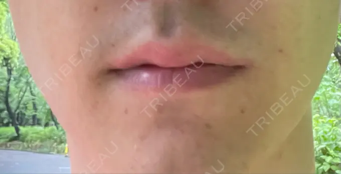 ボトックス（エラ・小顔） TCB東京中央美容外科 新宿三丁目院 BEFORE メイン用