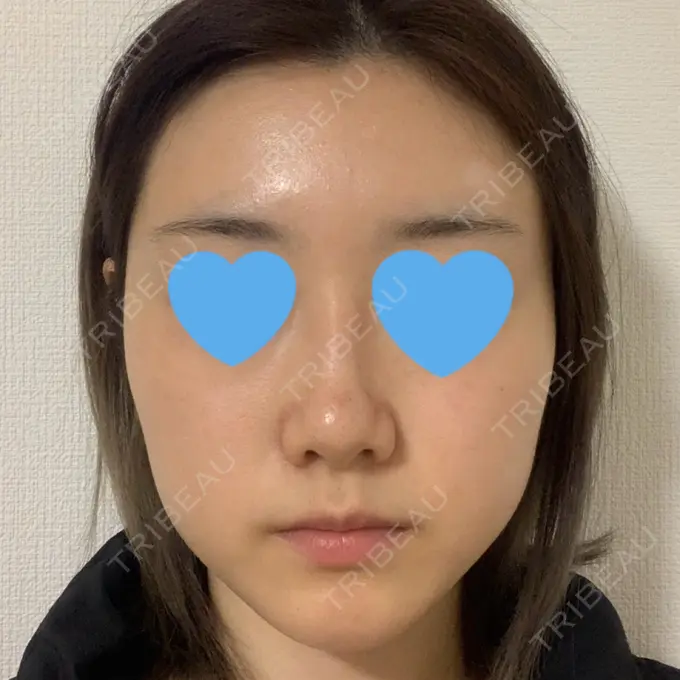 鼻中隔延長（非切開） TCB東京中央美容外科 八王子院 BEFORE メイン用