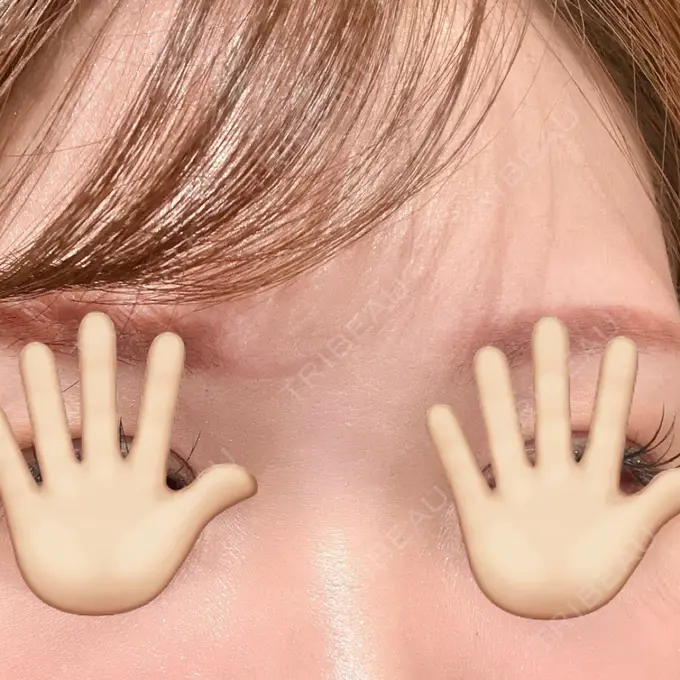 小鼻縮小（非切開） / シワ取りボトックス / ボトックス（眉間） / その他（鼻） TCB東京中央美容外科 横浜駅前院 BEFORE メイン用