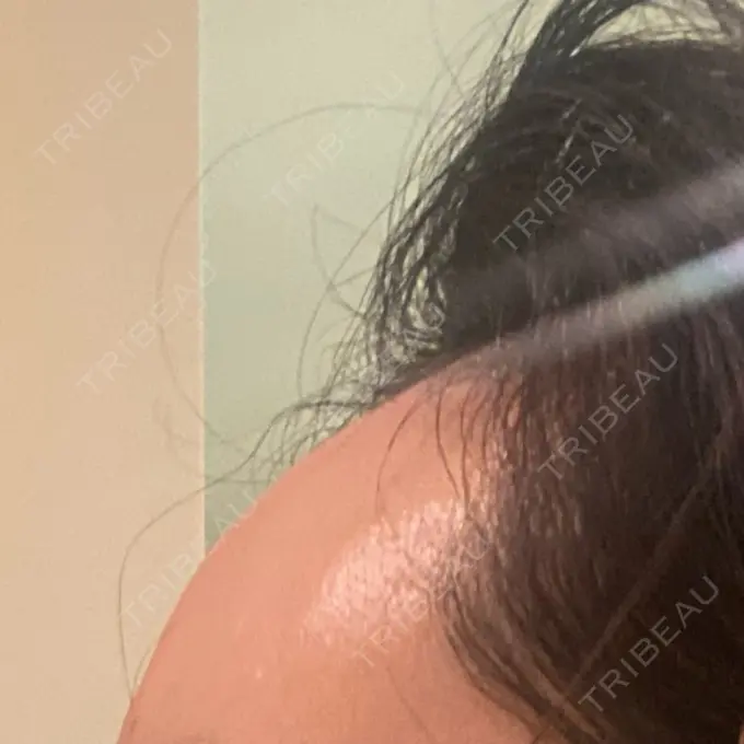 ヒアルロン酸注入（額） / ヒアルロン酸注入（頬） / ヒアルロン酸注入（こめかみ） / ボトックス（眉間） LA CLEF CLINIC（ラクレクリニック） BEFORE メイン用